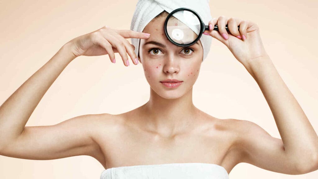 tratamientos-para-el-acne