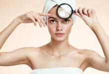 tratamientos-para-el-acne